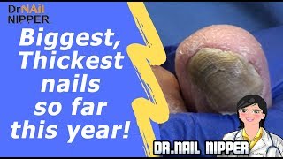 Why thick toenails?  Biggest, Thickest nails so far this year!  And a bonus Ram's Horn Toenail