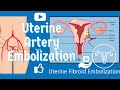 Uterine Artery Embolization