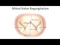 Understanding Mitral Regurgitation with Dr. Patrick McCarthy