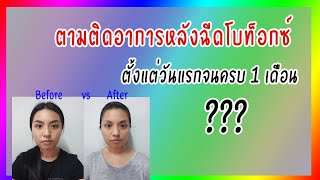 ตามติด!!..ผลลัพธ์หลังฉีดโบท็อกซ์ (Botox) ครบ 1 เดือน | Billista