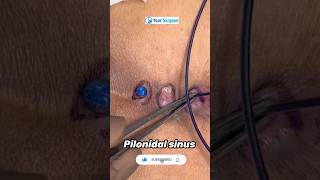 What is Pilonidal Sinus Cyst ? Pilonidal sinus treatment ? live pics of Pilonidal cyst ?