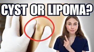 Lumps Under The Skin: Cyst Vs Lipoma