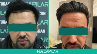 DHI Hair Transplant (3041 Grafts NW IIv-IIIv) by Dr Turan - FUECAPILAR, Istanbul, Turkey