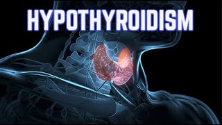 Hypothyroidism (updated 2023) - CRASH! Medical Review Series