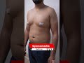 Gynecomastia Surgery result | Manboobs Surgery Cost #shortsvideo