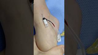 Iv cannula in foot 🦶#trending #shorts #ytshots