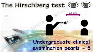 The Hirschberg Test | Undergraduate clinical examination pearls - 5