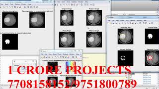 Brain Tumor Detection Using SVM Classifier-1Crore Projects