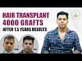 Hair Transplant (4000 Grafts) Real Testimonial After 1.5 Years Results | Care Well Medical Centre