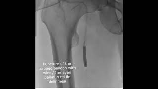 Popliteal directional atherectomy