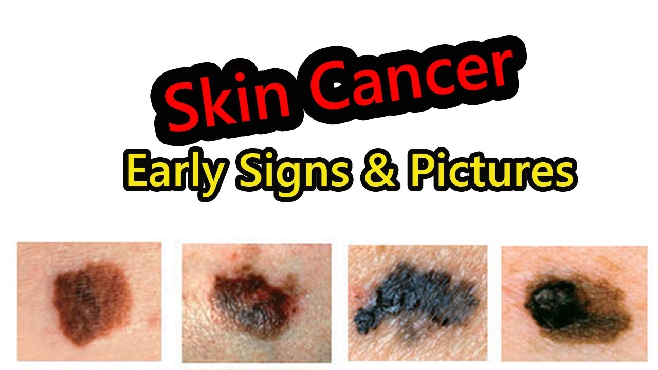 Early Signs Of Skin Cancer Melanoma You Must Know - YouTube