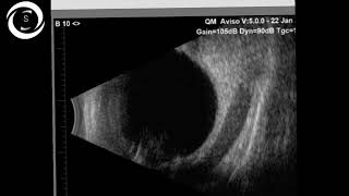 Ophthalmic Signs Bscan