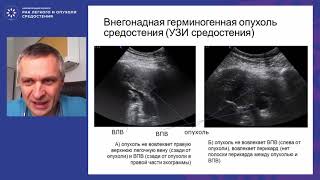 Опухоли средостенья – разнообразие морфологических форм, лечебных алгоритмов и тактических ошибок