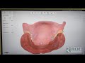 3shape trios scanner how to scan an upper and lower denture and bite