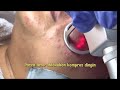 Spill Proses Laser Co2 Fractional | Laser Bopeng | Scar | Bekas Jerawat | dr. Deka