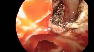 Endoscopic Repair of CSF Leak from Left Supraorbital Ethmoid Sinus