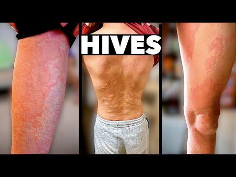 Are all allergic reactions the same?