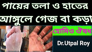 পায়ের তলা ও হাতের আঙ্গুলে গেজ বা কড়া,Payer tola gej,hater anggule gej,homeo madicine, Dr.Utpal Roy,