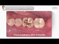 37 implant placement with flapless surgery dr. cho yongseok