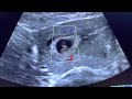 normal size of fetus at 7weeks in mm cm ultrasoundscans fetaldevelopment 7weeks pregnancy fetus