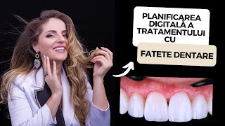 Cum se pun FATETE DENTARE?