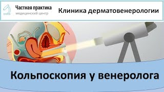 Кольпоскопия у венеролога