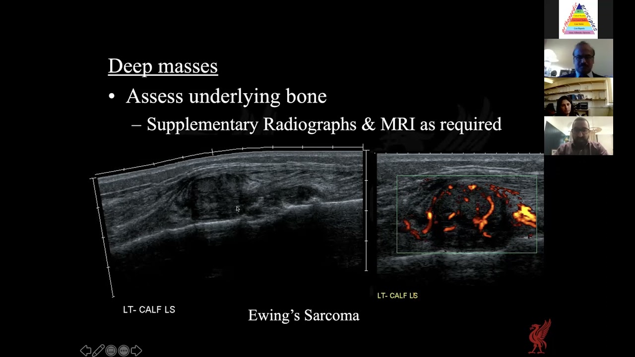 Radiological Approach To Soft Tissue Bumps And Sarcomas - YouTube