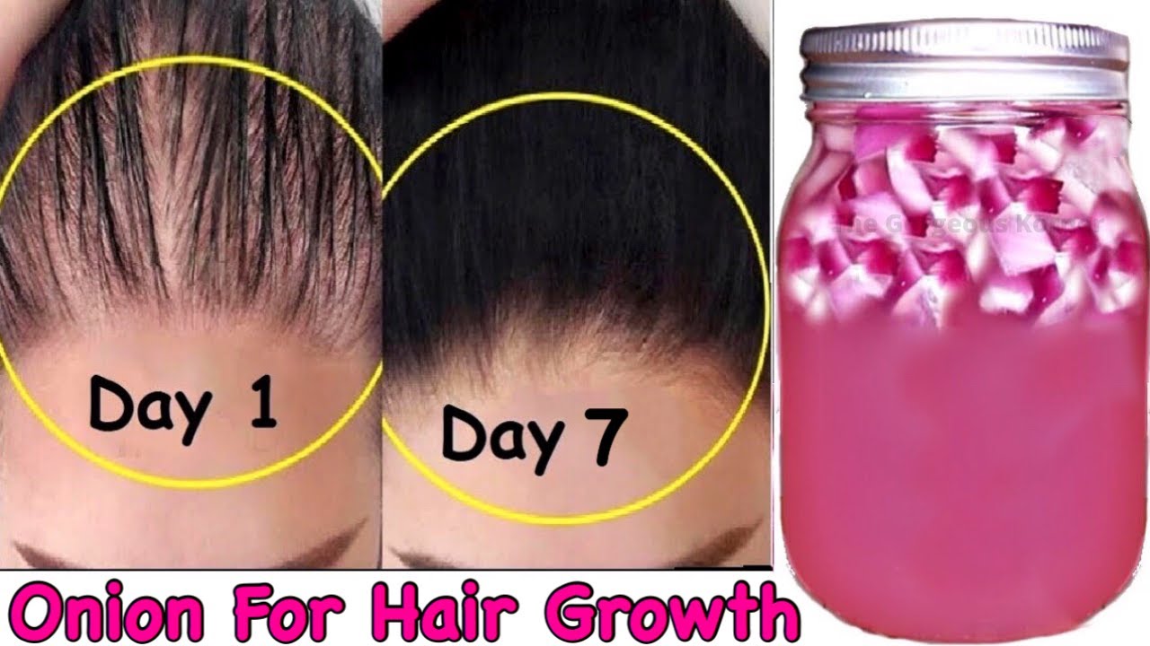 ONION FOR EXTREME HAIR GROWTH | How To Use Onion Juice For Hair Growth ...