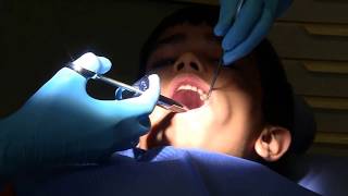 Tooth filling in school dental clinic  Part 2 [Tooth filling]