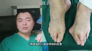 有拇外翻是否就需要特别在意？hallux valgus