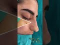 the unique closed atraumatic rhinoplasty technique by dr suleyman tas