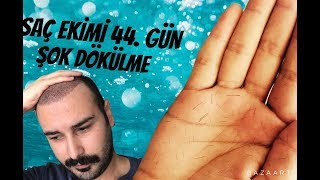 SAÇ EKİMİ 44. GÜN ŞOK DÖKÜLME - VİDEO 4