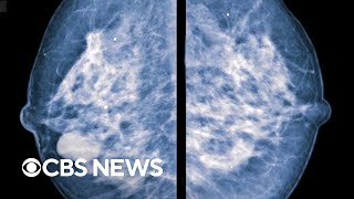 Contrast-enhanced mammography can identify 3x as many tumors in dense-breasted patients, study says