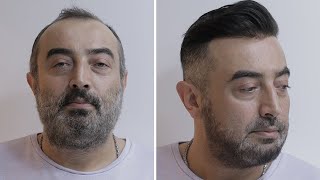 PROTEZ SAÇ - Saçsızlık Sorununu Bir Saatte Çöz! - Hair Replacement