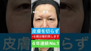 60代女性に奇跡の若返り 目の下のクマ取りたるみ取り美容整形 予約は☎️0120489100 #美容整形#目の下のたるみ#目の下のくま#くまとり#クマ取り#目の下のクマ#shorts