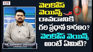 వెరికోస్ వెయిన్స్ రావడానికి గల ప్రధాన కారణం? | Varicose Veins Problems | CVR Health