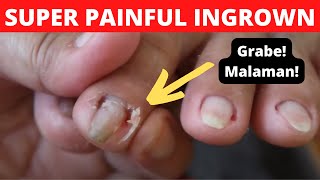 iNGROWN TOENAIL REMOVAL | Alma's Manicure and Pedicure Vlogs Philippines