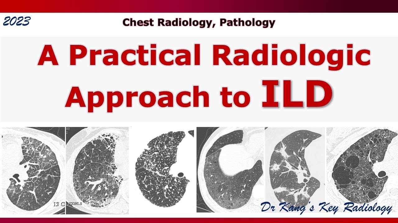 ILD, A Radiologic Approach - YouTube