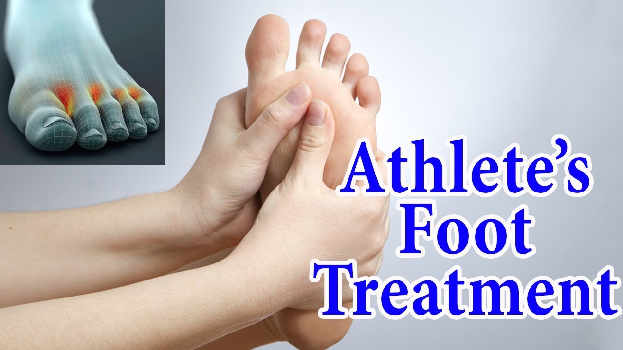 Athlete's Foot Fungal Infection Home Treatment | 5 Ways To Treat ...