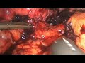 dr thibaut coste bleeding post sleeve gastrectomy