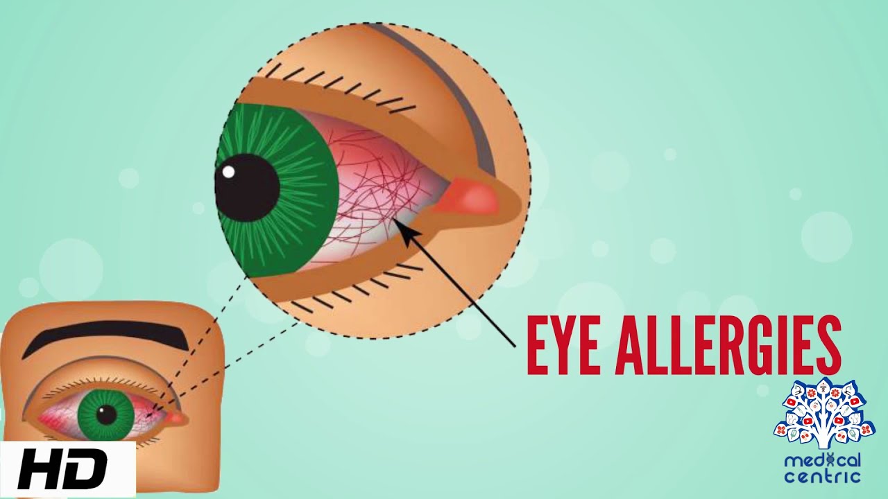 Eye Allergy, Causes, Signs And Symptoms, Diagnosis And Treatment. - YouTube