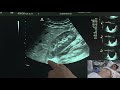 Ultrasound of the Urinary Tract