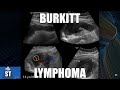 Sonoquickies - Burkitt’s Lymphoma