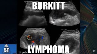 Sonoquickies - Burkitt’s Lymphoma