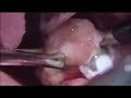 coblation tonsillectomy