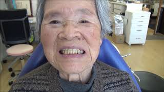 92歳 義歯装着の威力