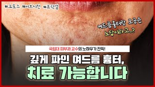 여드름 흉터와 모공, 피부과 시술로 해결할 수 있나요?🤔｜여드름 흉터 치료 보다 더 중요한 것이 이거!🔥｜프락셀, 크로스, 서브시전 다 알려줌! - [언니네피부과]