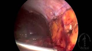 Transvaginal Nephrectomy - Dissection of Toldt's line