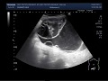 Ultrasound Video showing a huge multi-septic ovarian cyst.