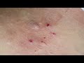 extract acne in nape hhv clinic